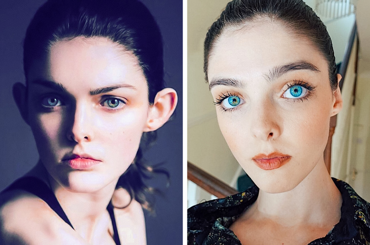 11 Models With Physical Imperfections Who Are Still Sparkling With Beauty